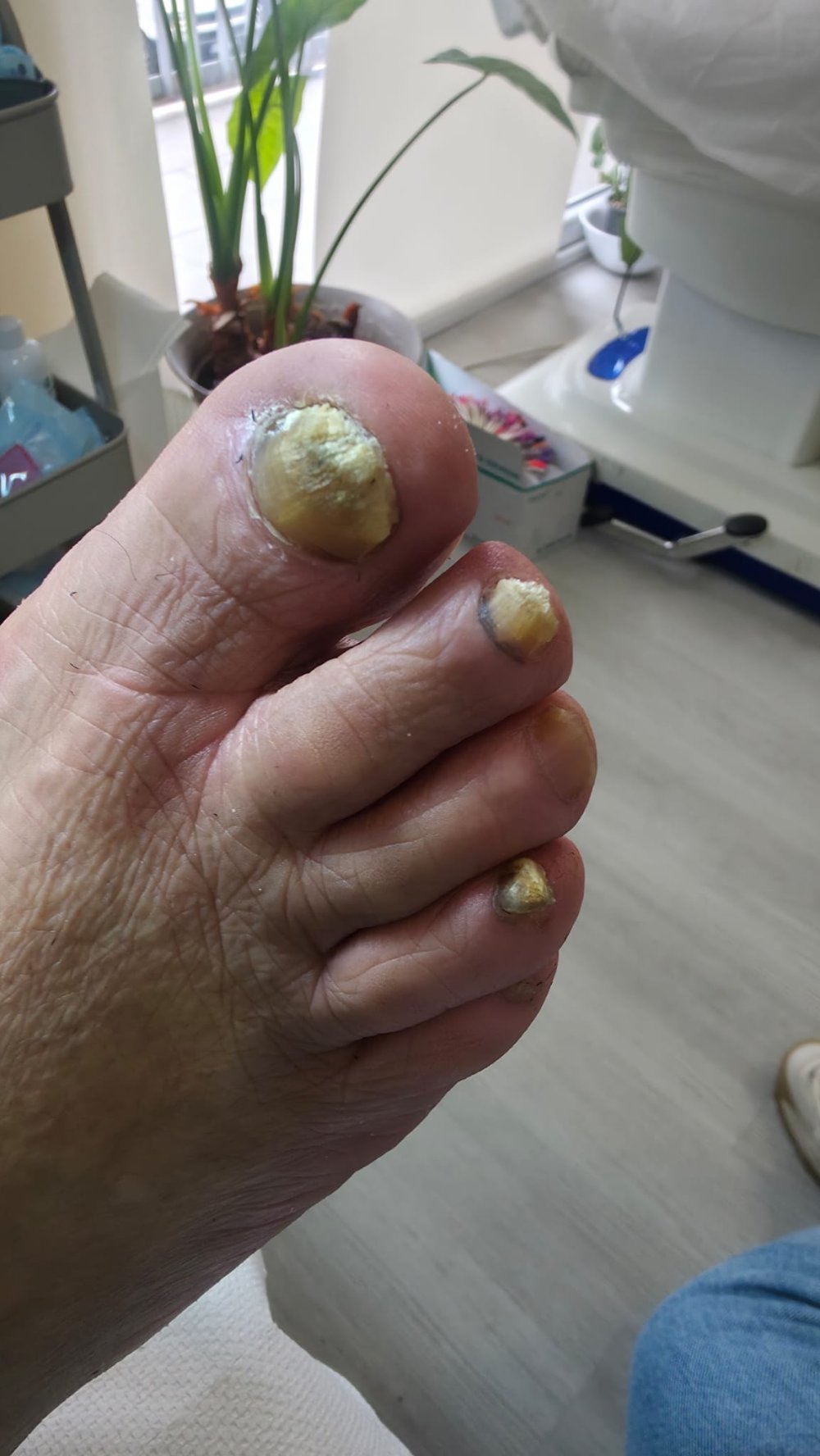 Îngrijirea unghiilor cu onicomicoză — fotografie înainte de îngrijire